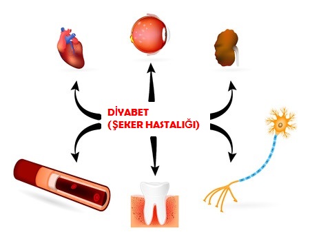 Diyabetik Nöropati Ile Hipertansiyon Arasında Bir Ilişki Var Mıdır? | Türk Diyabet Cemiyeti